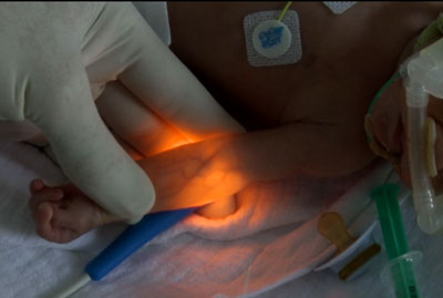 Vein illumination in small infant using Astodia